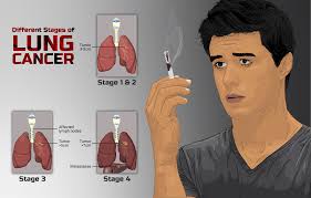 Breaking the Stigma: Lessons from HIV Helping Lung Cancer Patients