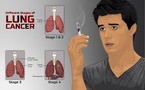 Breaking the Stigma: Lessons from HIV Helping Lung Cancer Patients Breaking the Stigma: Lessons from HIV Helping Lung Cancer Patients